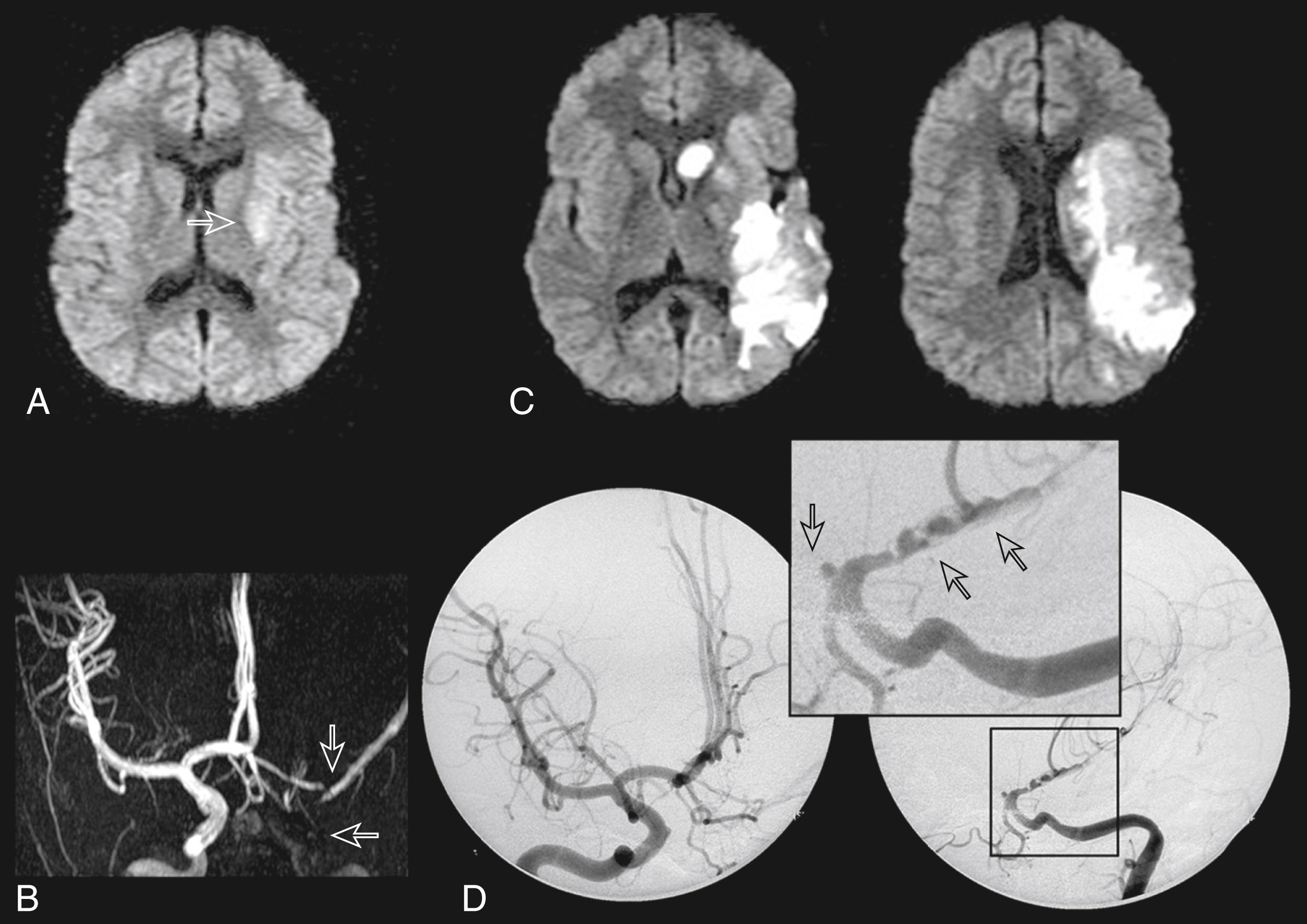 Fig. 31.1, Large-vessel cPACNS. A healthy 5-year-old child presented with acute-onset right hemiparesis. A, Diffusion magnetic resonance imaging (MRI) at 6 hours shows restricted diffusion limited to the left putamen. B, Magnetic resonance angiography (MRA) shows loss of flow in the left internal carotid artery (ICA) and proximal MCA. C, After clinical deterioration with dysphasia and worsening weakness on day 2, repeat diffusion MRI shows new restricted diffusion throughout the MCA territory including the caudate nucleus and frontal, parietal, and temporal lobes. D, Conventional angiography (left ICA injection) demonstrates severe irregularity of the distal ICA and proximal MCA with alternating striae or “bands” of narrowing (the right ICA is normal). Years later, the child has moderate hemiparesis, language dysfunction, learning delays, and epilepsy.