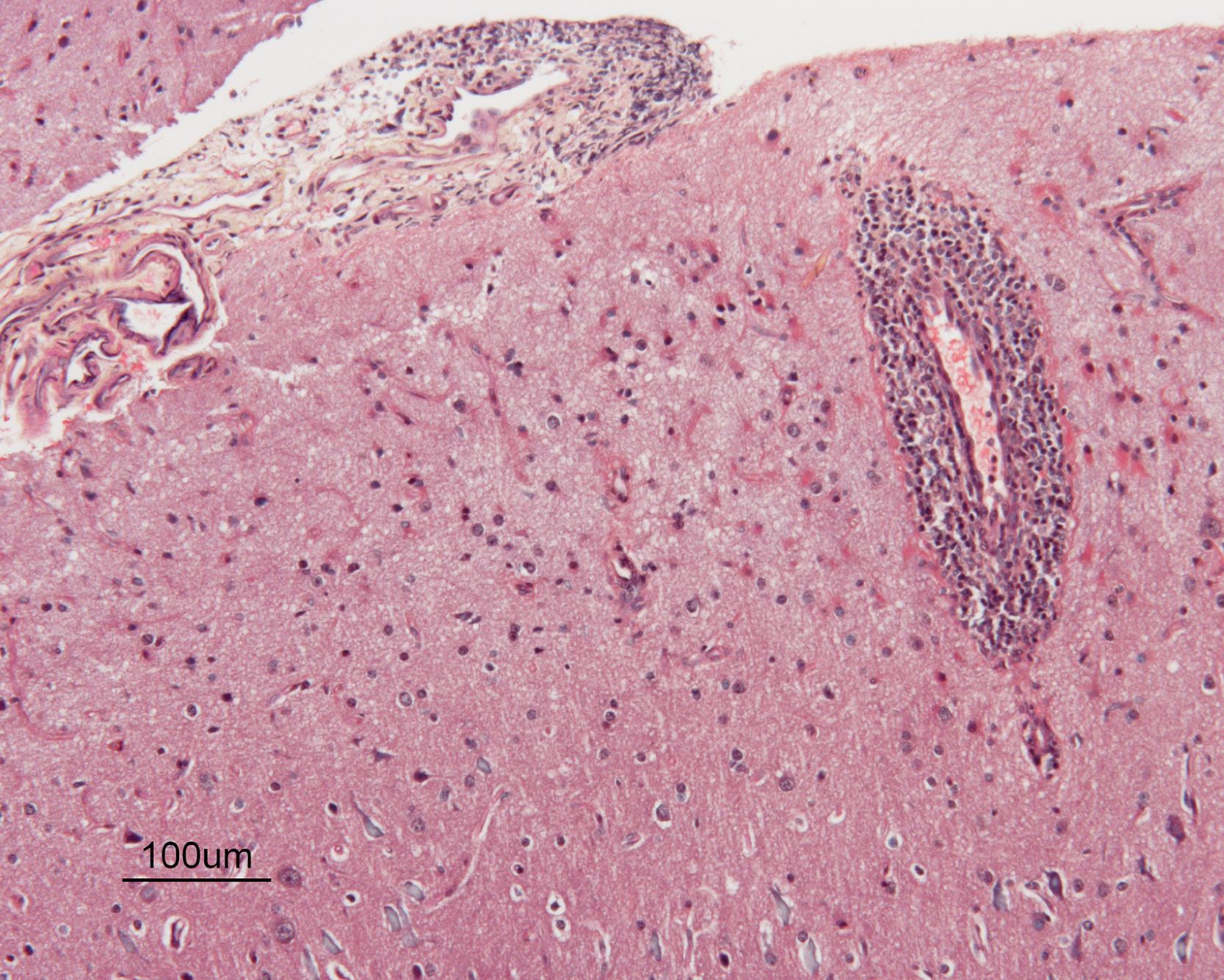 Fig. 31.2, Elective nonlesional brain biopsy in a 5-year-old child with primary small-vessel vasculitis. Masson stain demonstrates intramural and perivascular mononuclear infiltrates in small muscular arteries of the cortical gray matter and the leptomeninges (magnification ×400).