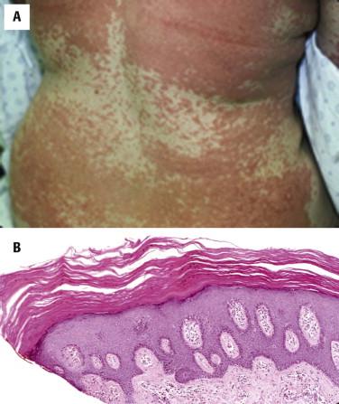 FIGURE 1-11, Pityriasis rubra pilaris. A, Coalescent orange-red papules with islands of sparing. B, Alternating orthokeratosis and parakeratosis (checkerboard pattern), psoriasiform epidermal hyperplasia, and sparse superficial perivascular lymphocytes.