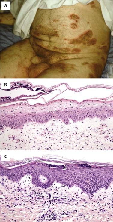 FIGURE 1-12, Necrolytic migratory erythema (glucagonoma syndrome) in a 74-year-old man with markedly elevated serum glucagon level and pancreatic mass. A, Erythematous, erosive desquamating plaques in a flexural distribution. B, Initial biopsy revealed vacuolization and pronounced pallor in the superficial epidermis. Necrolysis is not yet evident. C, Subsequent biopsy revealed only focal subcorneal pustule formation. Thus, prominent necrolysis is not always a feature, and the findings may resemble psoriasis or other inflammatory disorders.