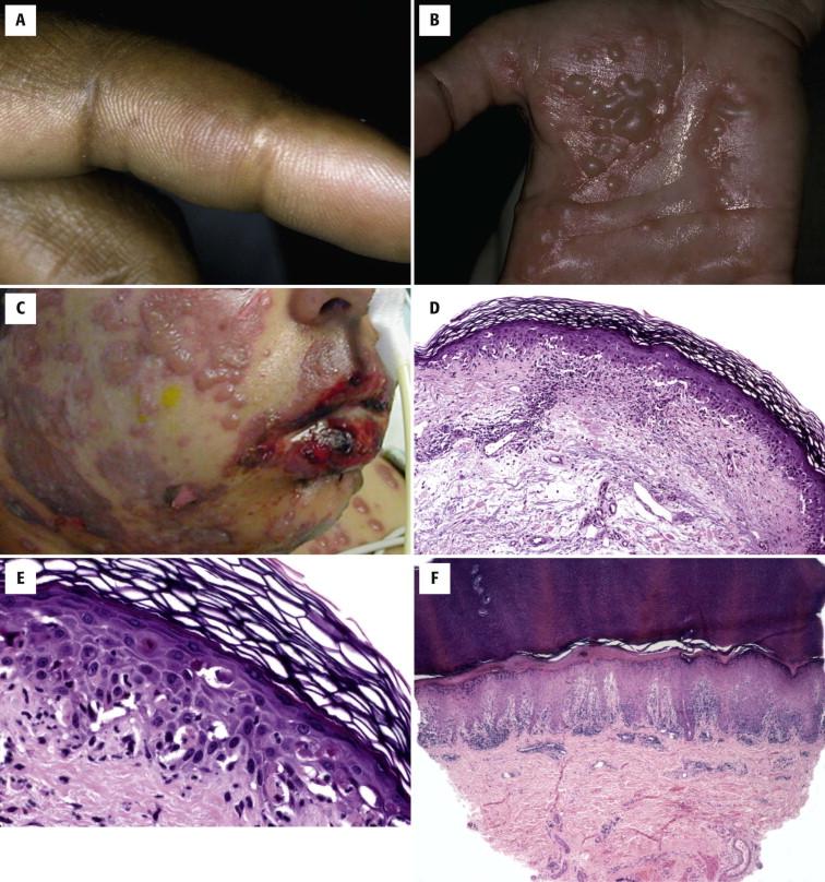 FIGURE 1-13, Erythema multiforme (EM) and Stevens-Johnson syndrome (SJS). A, Targetoid papule on the lateral finger that resolved with acyclovir therapy. B, Bullous eruption on the palms associated with a cold sore. C, Hemorrhagic crusted lesion with lip involvement in SJS. D, Basket-weave orthokeratosis, vacuolar interface dermatitis, and superficial lymphocytes in the dermis. E, Prominent single necrotic keratinocytes at all levels of the epidermis. F, Biopsy from the patient in part A reveals a denser lichenoid infiltrate. G, Prominent keratinocyte necrosis. H, Satellite cell necrosis. I, J, SJS is characterized by confluent epidermal necrosis and subepidermal clefting. These changes are indistinguishable from some cases of bullous EM. In toxic epidermal necrolysis, inflammation may be absent or minimal, but biopsy of perilesional skin may reveal changes indistinguishable from SJS or EM.