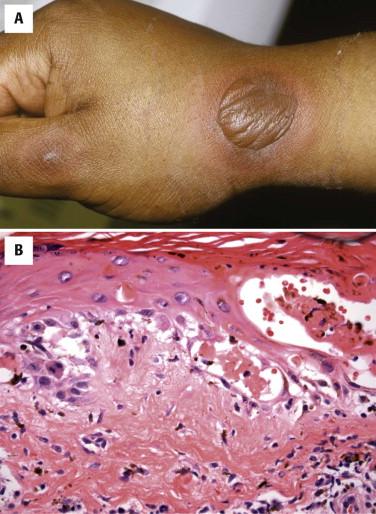 FIGURE 1-14, Fixed drug reaction. A, Dusky red, hemorrhagic, bullous, round plaque on the wrist. Smaller lesion on the thumb. B, Vacuolar and lichenoid interface dermatitis with prominent necrotic keratinocytes. Dermal eosinophils are present. Melanophages are often prominent.