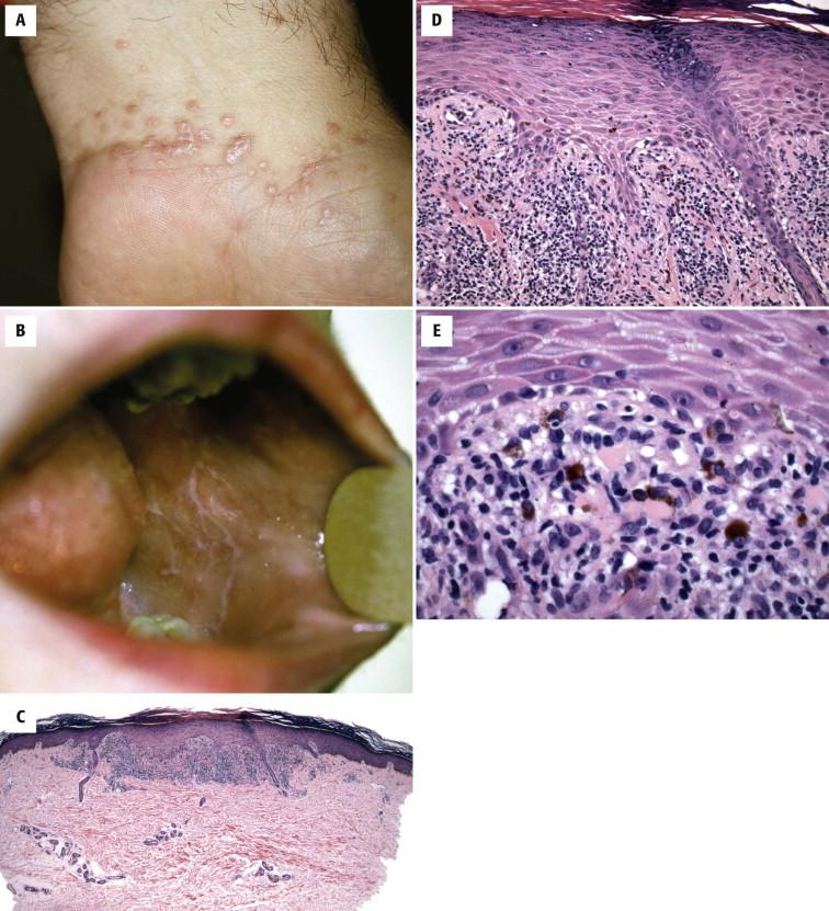 FIGURE 1-15, Lichen planus. A, Round and polygonal papules with Wickham striae on the inner wrist. B, Reticulated white patch on the buccal mucosa. C, D, Lichenoid interface dermatitis with epidermal hyperplasia, sawtooth-shaped rete ridges, and wedge-shaped hypergranulosis. E, Colloid bodies and melanophages in the papillary dermis.