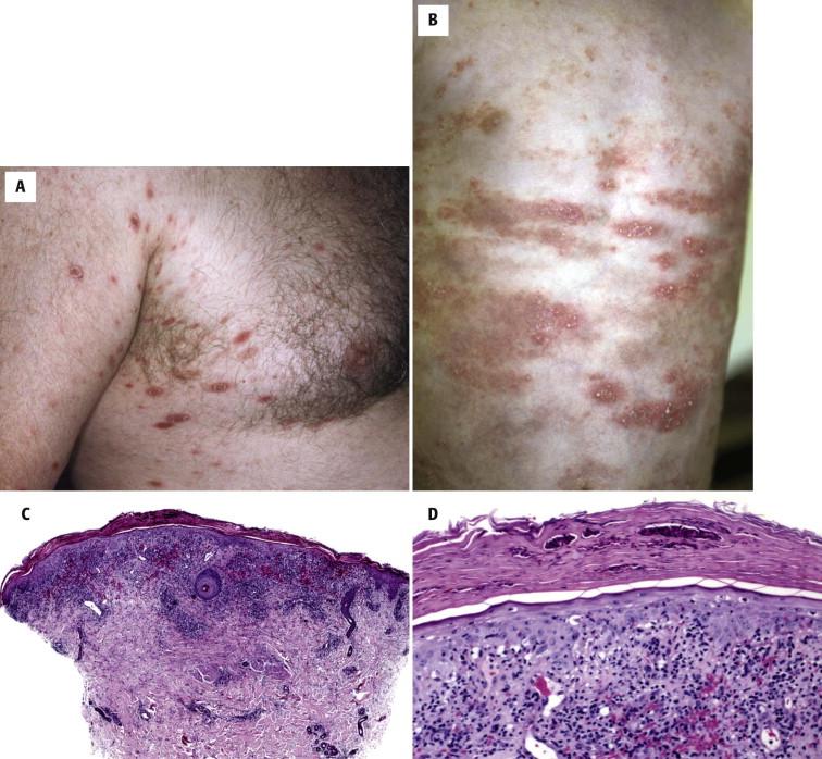 FIGURE 1-16, Pityriasis lichenoides. A, Erythematous papules on the trunk and extremities. B, Papulovesicles in pityriasis lichenoides et varioliformis acuta (Mucha Habermann disease). C, Scanning magnification reveals lichenoid interface dermatitis associated with a dense wedge-shaped lymphocytic infiltrate with deep perivascular extension and erythrocyte extravasation in the upper dermis. D, Higher magnification reveals a neutrophilic crust, lymphocyte exocytosis, vacuolar alteration, necrotic keratinocytes, and erythrocyte extravasation.