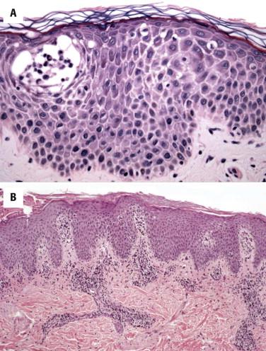 FIGURE 1-2, A, Acute spongiotic dermatitis. Spongiotic microvesiculation is the full expression of intercellular edema (spongiosis) that is the hallmark of all forms of spongiotic dermatitis, including allergic contact, nummular, dyshidrotic, and atopic dermatitis. In most cases, the diagnosis is established without biopsy. B, Chronic spongiotic dermatitis is characterized by compact orthokeratosis and irregular psoriasiform epidermal hyperplasia. Compared with psoriasis, the granular layer is retained or thickened in many areas; spongiosis may be less prominent.