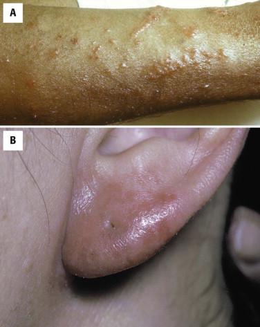 FIGURE 1-3, Allergic contact dermatitis. A, Vesicles in linear array secondary to poison oak exposure. B, Secondary to nickel in jewelry.