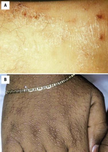 FIGURE 1-4, Atopic dermatitis. A, Ill-defined plaques composed of pruritic focally crusted papules (in many instances ruptured papulovesicles) that become lichenified secondary to chronic rubbing. B, Papular or follicular atopic dermatitis is more common in dark-skinned children and clinically resembles lichen nitidus.