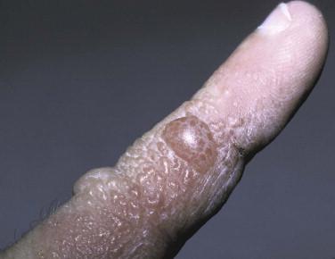 FIGURE 1-5, Dyshidrotic dermatitis consists of pruritic vesicles that tend to arise on the lateral fingers and hands. In contrast to spongiotic vesicles at other sites, they often remain intact in dyshidrosis.