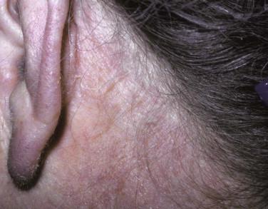 FIGURE 1-6, Seborrheic dermatitis is rarely biopsied. There is usually ill-defined, greasy, soft scale involving the scalp, and nasolabial and retroauricular skin folds.