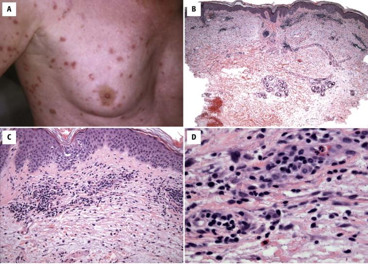 FIGURE 1-7, Papular dermatitis (subacute prurigo, itchy red bump disease). A, Numerous edematous red pruritic papules with variable crusting (from excoriation) on the trunk and proximal extremities. B, Scanning magnification reveals superficial and mid perivascular and interstitial lymphocytes. C, D, Closer inspection reveals focal spongiosis and dermal eosinophils. Urticarial dermatitis is histologically identical to papular dermatitis.