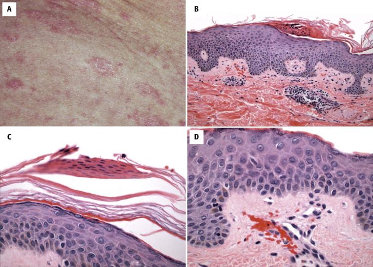 FIGURE 1-8, Pityriasis rosea. A, Characteristic oval plaque with collarette of pityriasiform (branlike) scale oriented along relaxed skin tension lines. B, C, Focal “caps” of parakeratosis and spongiosis are typically focal. D, Extravasated erythrocytes in the papillary dermis.