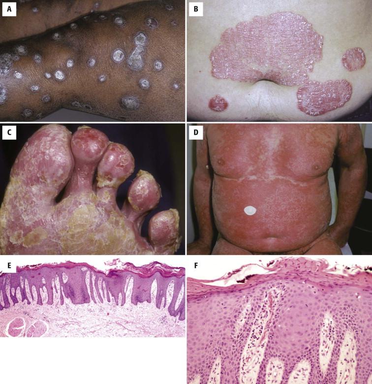 FIGURE 1-9, Psoriasis. A, B, Classic well-demarcated plaques with a thick scale. C, Pustular psoriasis. A few intact pustules are present at the base of the great toe. D, Erythrodermic psoriasis. E, At scanning magnification, there is regular elongation of the rete ridges. F, Parakeratotic crust, hypogranulosis, and a thinned suprapapillary plate. G, Neutrophilic spongiosis. H, Layered neutrophils within parakeratosis. I, Collections of neutrophils in the stratum corneum (Munro microabscess) and in the stratum malpighii (spongiform pustule of Kogoj). J, Spongiform pustule at higher magnification. K, L, Pustular psoriasis may be generalized or localized to acral skin (whereupon the clinician has no choice but to biopsy at this site, as shown in the figure).