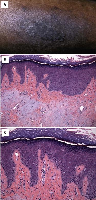 FIGURE 1-10, Lichen simplex chronicus. A, Thickened, hyperpigmented plaque with decreased numbers of more prominent skin lines. B, C, Compact orthokeratosis, hypergranulosis, papillary dermal fibrosis, and vertically oriented blood vessels within papillary dermal tips. In this case, the dermal fibrosis is more obvious because it displaces solar elastosis.