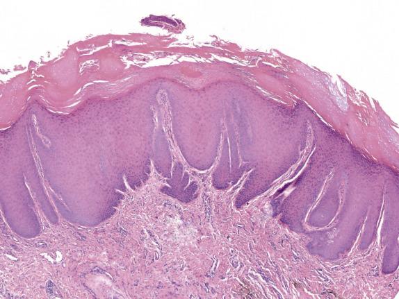 FIG. 1.11, Lichen simplex chronicus. There is marked irregular acanthosis with thick rete ridges of variable sizes, compact orthokeratosis, areas of hypergranulosis, and focal parakeratosis.