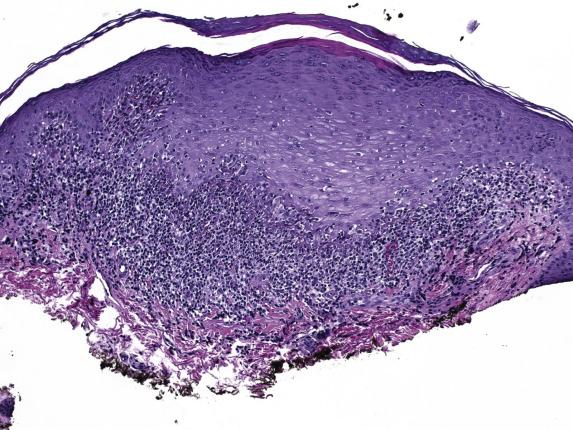 FIG. 1.13, Lichen planus. A band-like (“lichenoid”) infiltrate is present at the dermoepidermal interface. The overlying epidermis is acanthotic with hyperkeratosis and hypergranulosis.