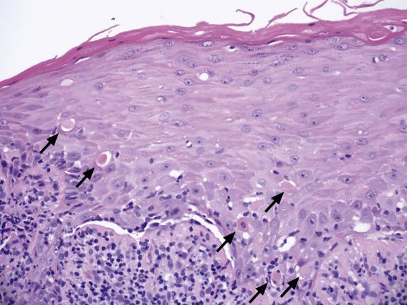 FIG. 1.14, Lichen planus. The lichenoid inflammation results in basal cell damage seen as squamatization of basal keratinocytes and dyskeratotic cells. Necrotic keratinocytes appear as eosinophilic hyaline ovoid bodies in the epidermis adjacent to the dermoepidermal junction (“Civatte bodies”, arrows ) or within the dermis (“colloid bodies”). Sharply angulated (“saw-tooth”) rete ridges are also appreciated.