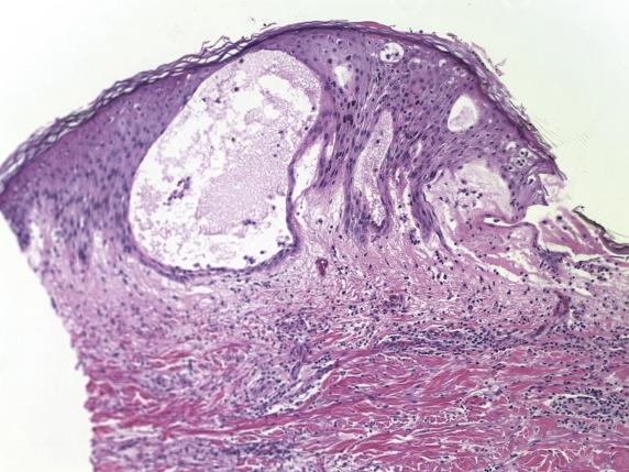 FIG. 1.2, Allergic contact dermatitis. Spongiosis leads to the formation of microvesicles within the epithelium imparting a “Swiss-cheese” appearance. There is associated lymphocyte exocytosis. The stratum corneum remains unchanged, in keeping with the acute nature of the insult.