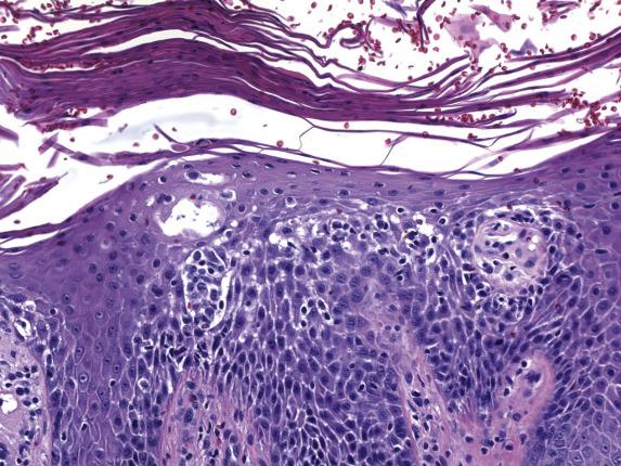 FIG. 1.5, Seborrheic dermatitis. As in other spongiotic dermatoses, there is psoriasiform epidermal hyperplasia with spongiosis and a parakeratotic scale crust. A lymphohistiocytic infiltrate can be seen in the papillary dermis.