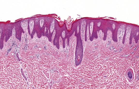 FIG. 1.7, Psoriasis. This lesion exhibits evenly distributed (regular) acanthosis, patchy loss of the granular layer (hypogranulosis), and thinning of the suprapapillary plates.