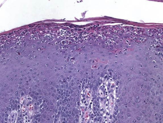 FIG. 1.8, Psoriasis. This mature lesion shows confluent neutrophil-rich parakeratosis and hypogranulosis. Neutrophil collections are seen within the stratum corneum (“Munroe microabscesses”) and the stratus spinosum (“spongiform pustules of Kogoj”).