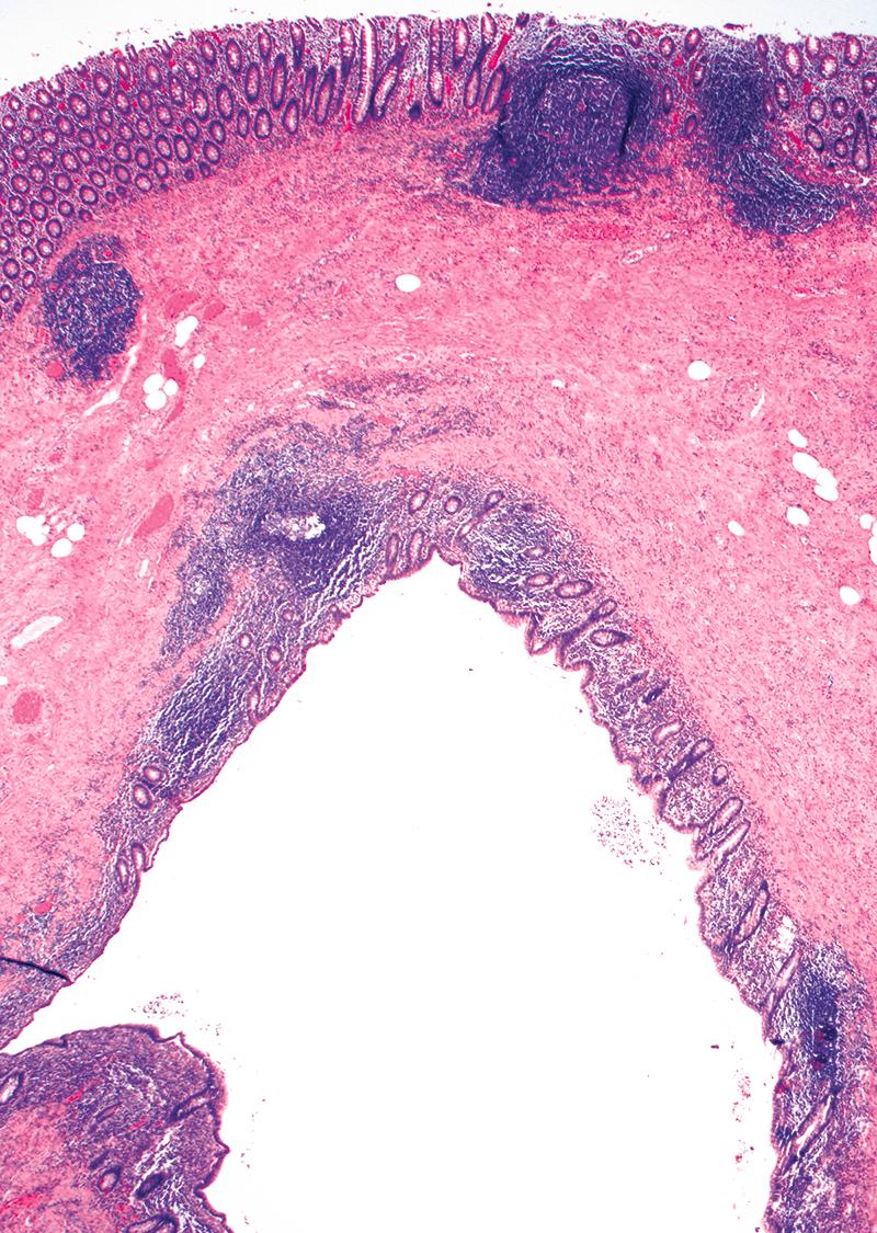 FIGURE 18.2, Complete appendiceal duplication is seen as an extra appendiceal lumen in the wall of the cecum in this case. This finding prompted surgery for suspicion of a cecal mass.