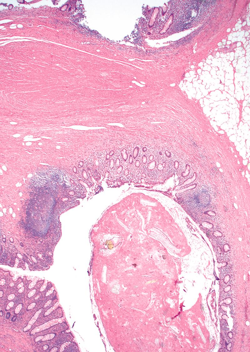 FIGURE 18.3, Acquired appendiceal diverticula are usually found in the distal appendix. They consist of herniations of mucosa and submucosa into the appendiceal wall.