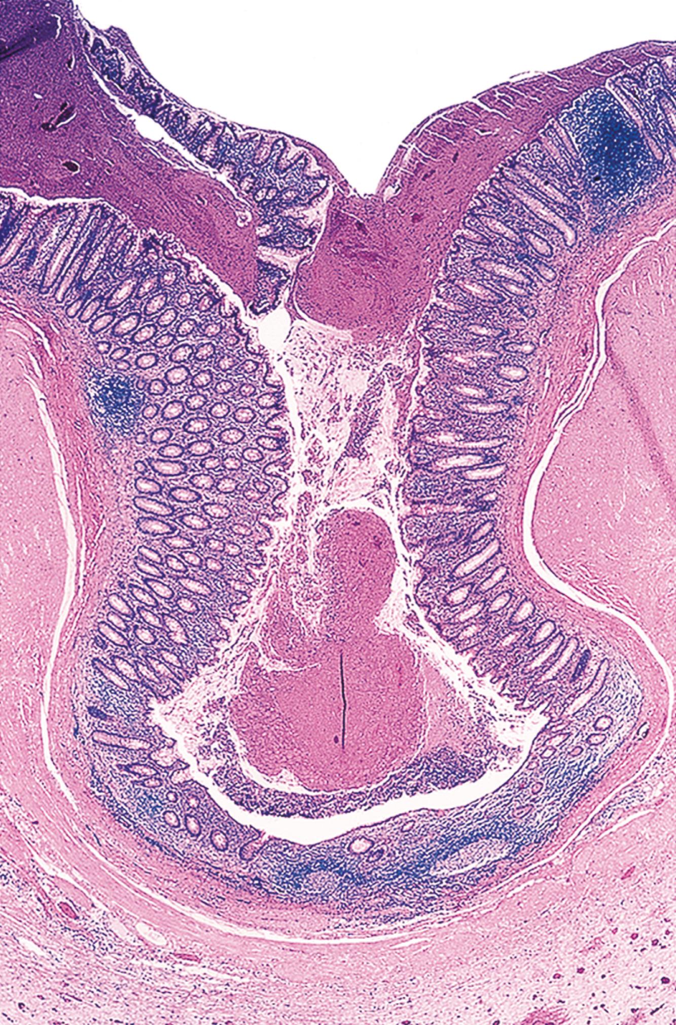 FIGURE 18.4, Acquired appendiceal diverticulum in a patient with cystic fibrosis.