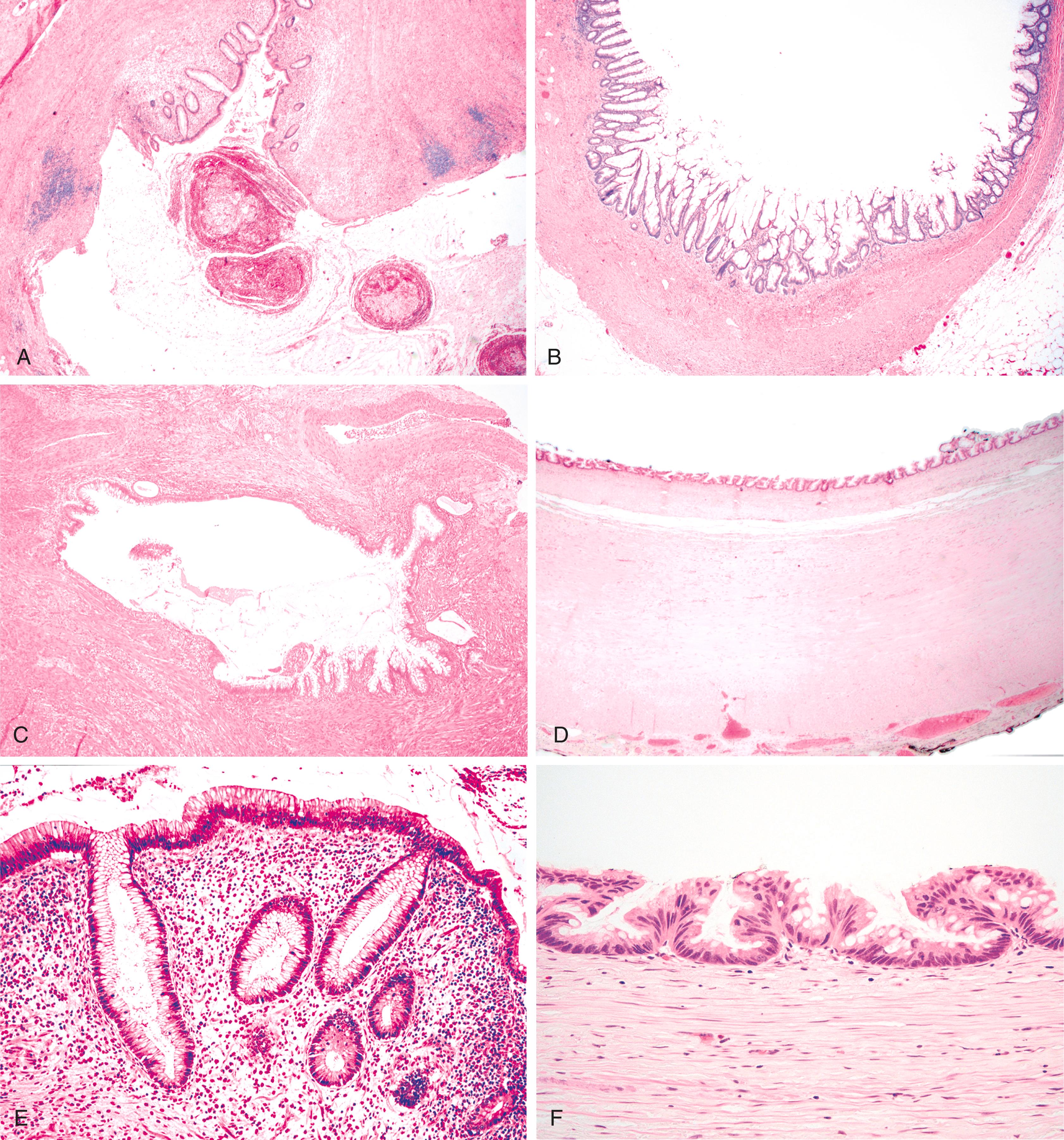 FIGURE 18.5, A , Diverticula may become dilated and contain inspissated mucin, simulating low-grade appendiceal mucinous neoplasm (LAMN). Diverticula are lined by normal-appearing appendiceal mucosa that may be slightly distorted or partially attenuated. B , LAMNs are lined by complex, villiform epithelial proliferations with markedly crowded neoplastic crypts. C , Diverticula are often associated with muscular hypertrophy, which is not a feature of LAMN. D , Increased luminal pressure causes thinning of the appendiceal wall and muscle fibrosis in LAMNs. E , The mucosal lining of diverticula contains a mixture of epithelial cells supported by abundant lamina propria. F , The epithelial lining of LAMN is monotonous and displays features of low-grade dysplasia. The lamina propria is obliterated.