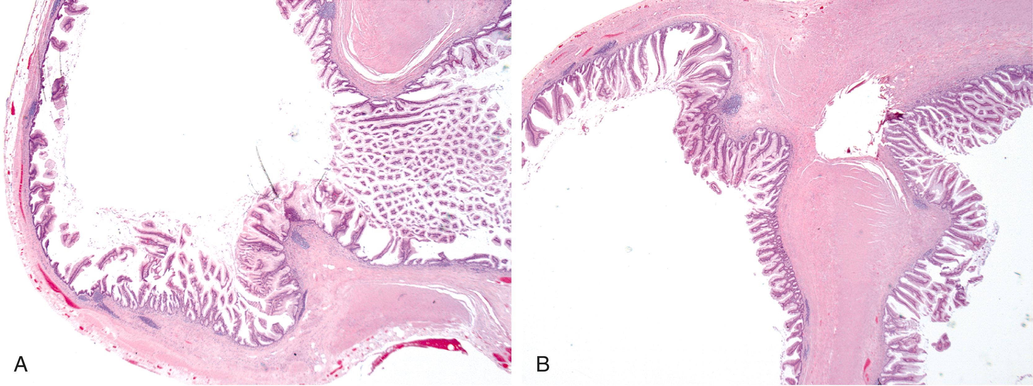 FIGURE 18.6, A, A LAMN is seen herniating through the appendiceal muscularis propria to form a diverticulum. B, The tumor features exuberant villiform tumor growth, which is appreciable both in the appendiceal lumen (right) and in the diverticular lining (left). (Courtesy Dr. Henry Appelman, The University of Michigan.)