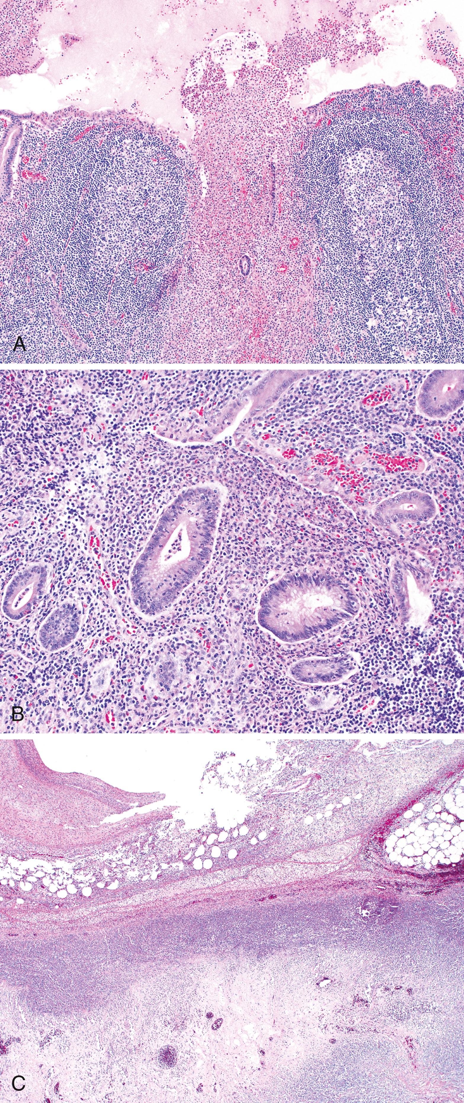 FIGURE 18.8, A, Acute suppurative appendicitis consists of a neutrophilic infiltrate that extrudes into the appendiceal lumen from the lamina propria. B, Cryptitis and crypt abscesses are invariably present. C, Progressive transmural inflammation results in serositis and perforation.