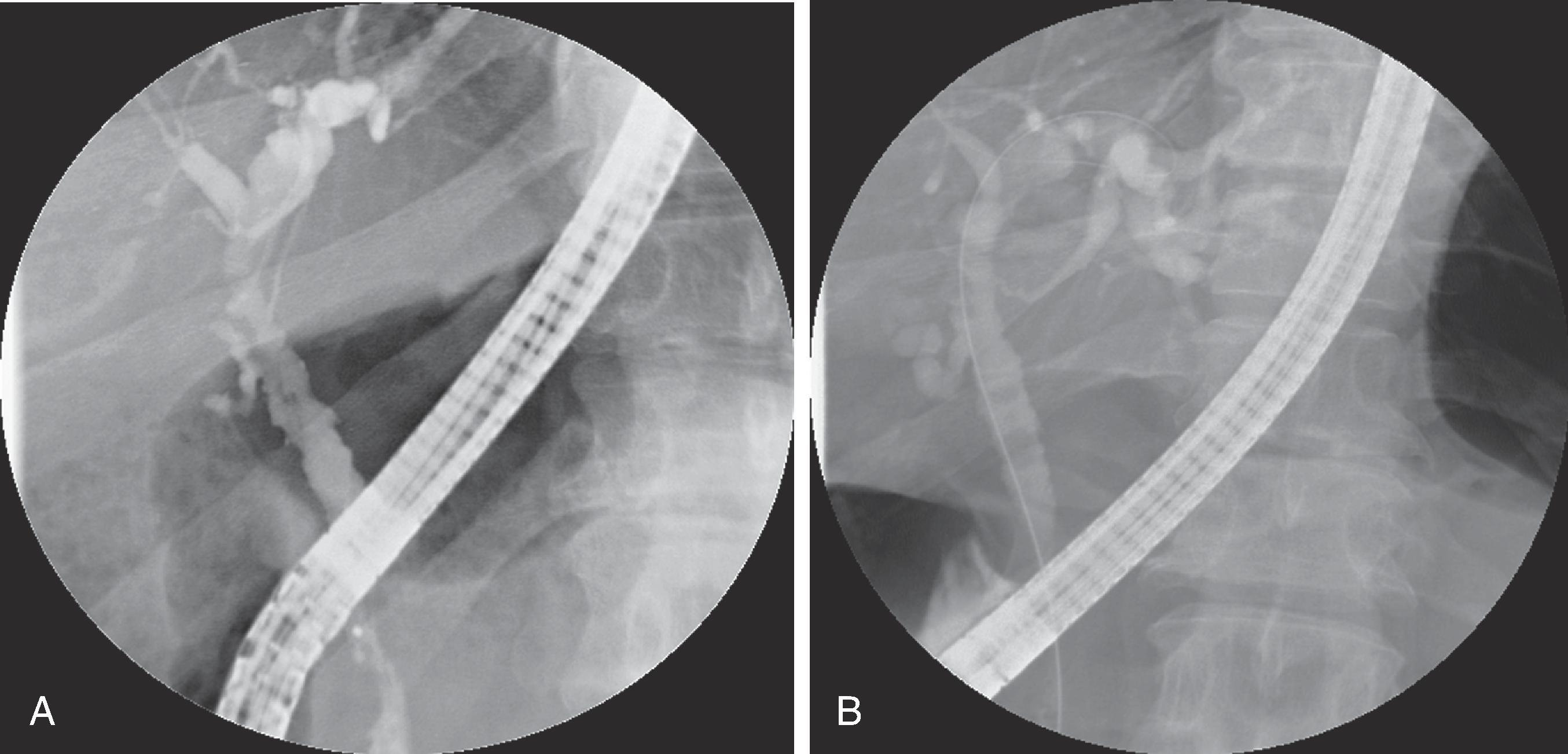 Fig. 51.1, Primary sclerosing cholangitis: endoscopic retrograde cholangiopancreatography findings. (A and B) There are multifocal, irregular strictures and dilations involving the intrahepatic and extrahepatic bile ducts. The strictures are usually short and annular, may appear as webs, and alternate with normal or slightly dilated segments, producing a beaded appearance. Coarse nodular mural irregularities as well as small eccentric outpouchings are often seen.