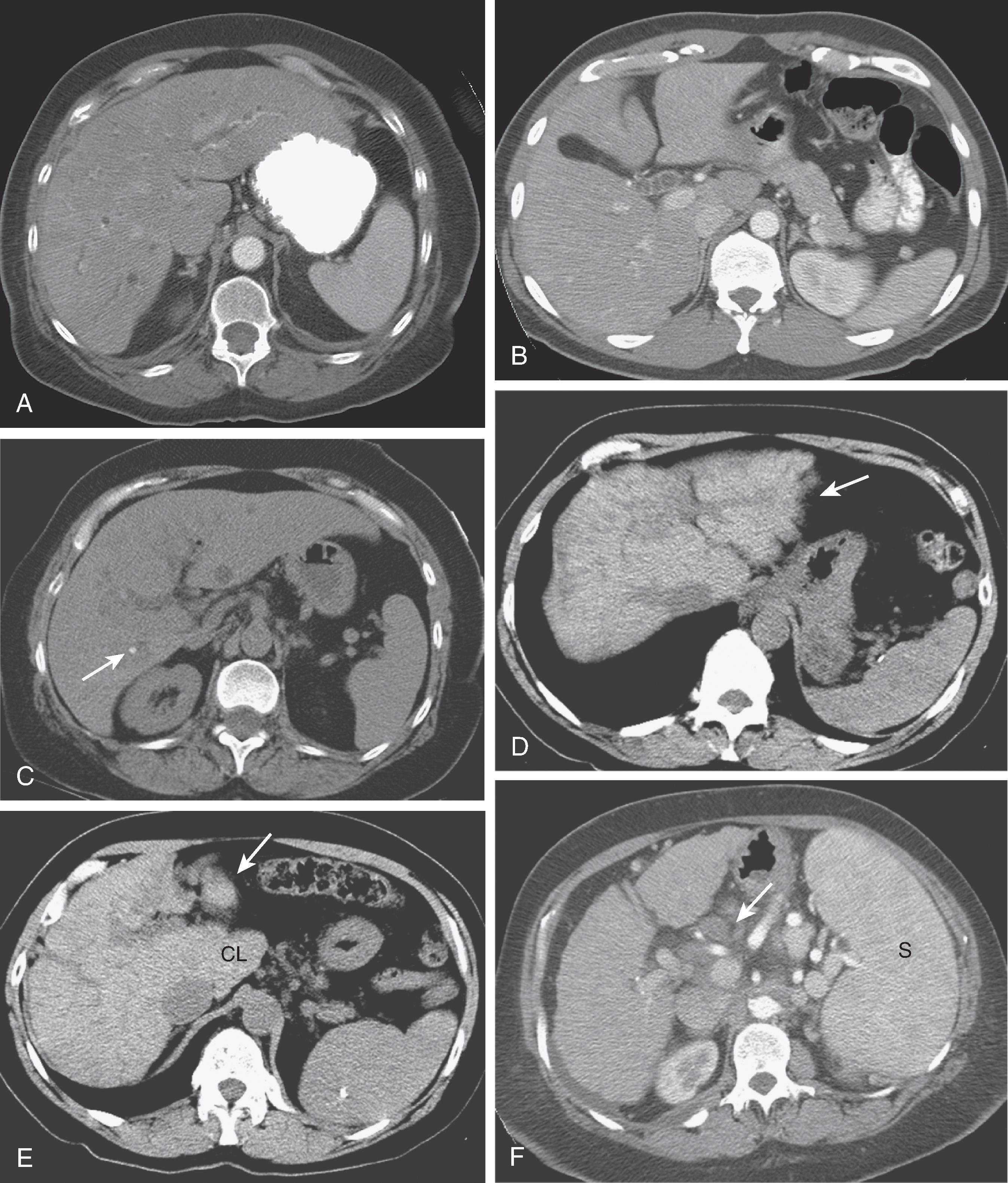 Fig. 51.2, Primary sclerosing cholangitis (PSC): computed tomography (CT) findings. (A) Irregular intrahepatic bile duct dilation with periductal hyperenhancement is seen. (B) Abnormal mural thickening and enhancement are identified in the common bile duct. (C) Non–contrast-enhanced scan shows an intrahepatic bile duct stone (arrow) . (D and E) In a different patient, non–contrast-enhanced CT scan shows a nodular liver with marked atrophy of the lateral segment of the left lobe (arrow) and enlargement of the caudate lobe (CL) . (F) Contrast-enhanced scan in a different patient shows cirrhosis of the liver, splenomegaly (S) , and adenopathy in the porta hepatis (arrow) , a common finding in patients with PSC.