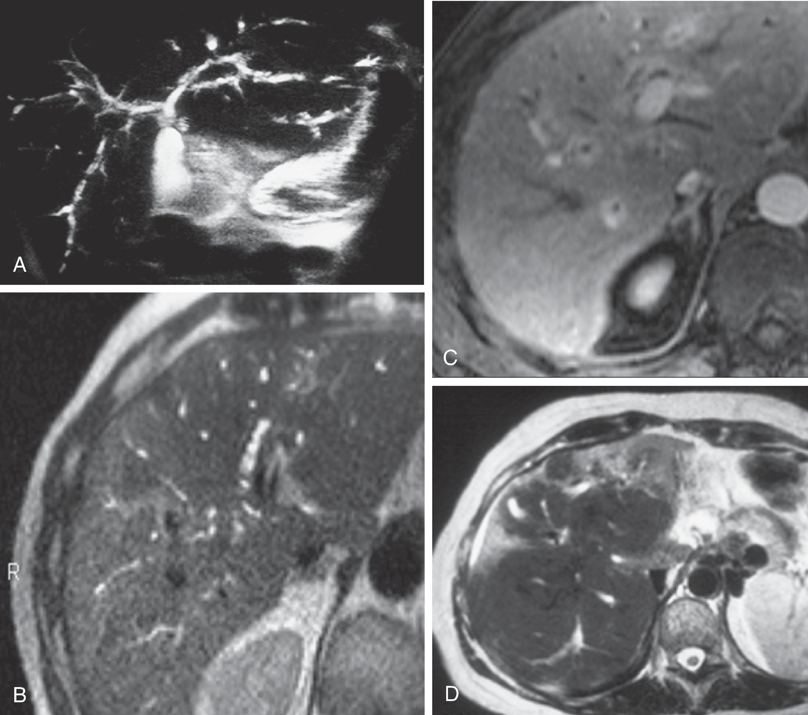 Fig. 51.3, Primary sclerosing cholangitis: magnetic resonance (MR) findings. (A and B) MR cholangiogram shows characteristic irregular strictures and segmental dilations of the intrahepatic and extrahepatic ducts. (C) Abnormal periductal enhancement is seen after contrast enhancement. (D) MR image of patient with secondary biliary cirrhosis due to sclerosing cholangitis.