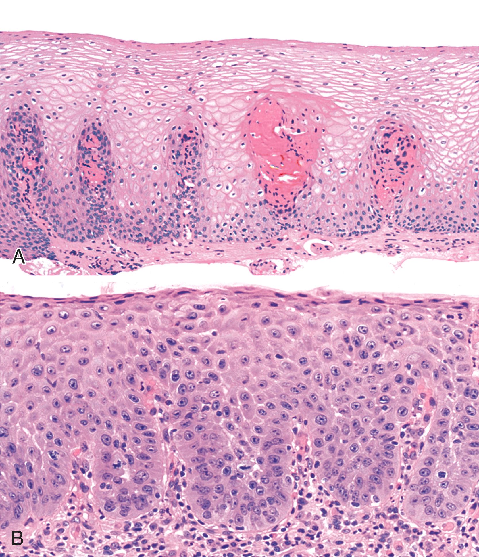 FIGURE 14.1, A, Normal squamous mucosa shows basal and suprabasal cells that involve less than 15% of the thickness of the epithelium. The lamina propria papillae involve approximately 50% of the thickness of the epithelium. B, In reflux esophagitis, there is basal and suprabasal cell hyperplasia, elongation of the lamina propria papillae, lack of surface maturation with the presence of nucleated squamous cells at the surface of the epithelium, and increased inflammation in the lamina propria.