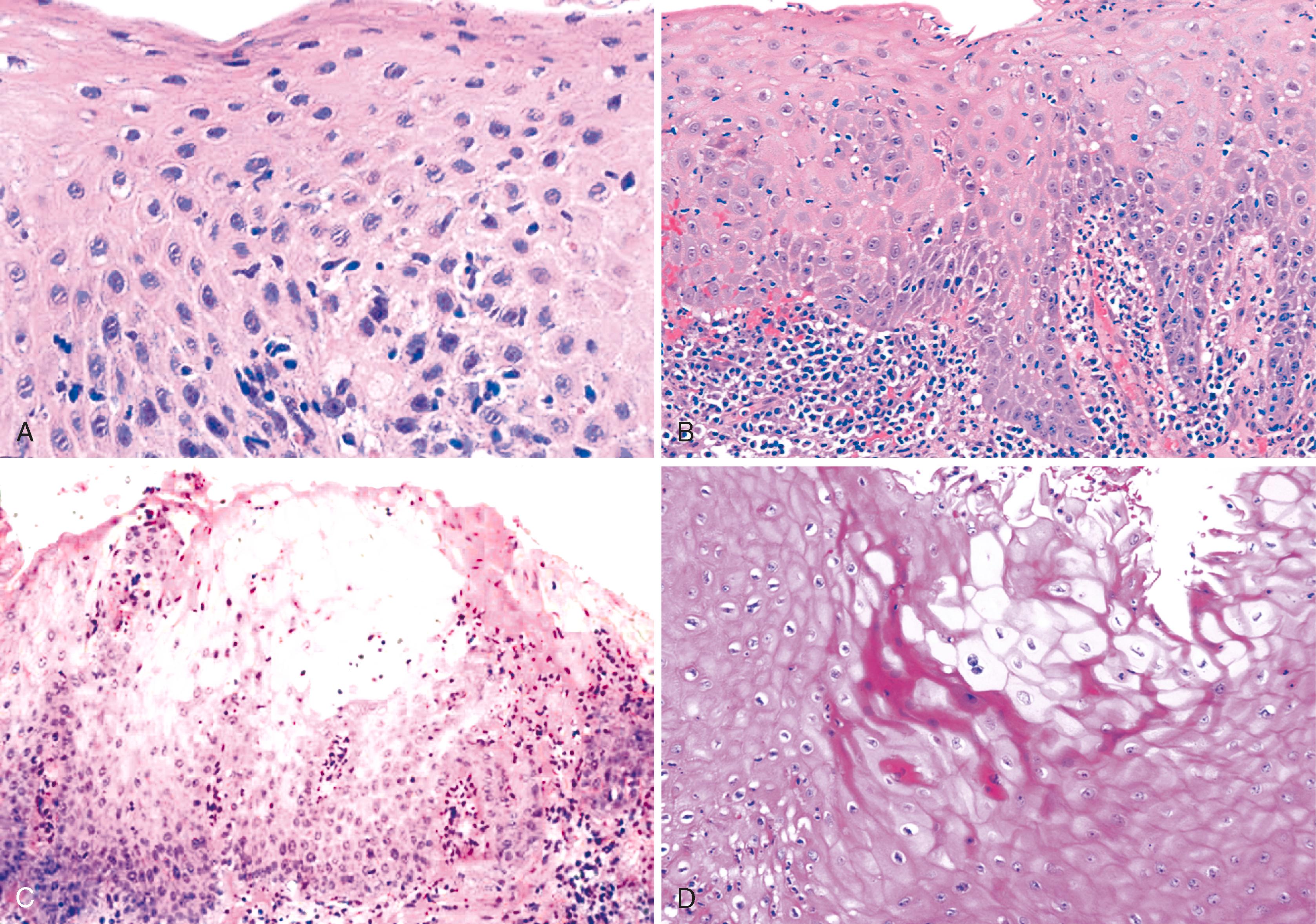 FIGURE 14.3, Reflux esophagitis.