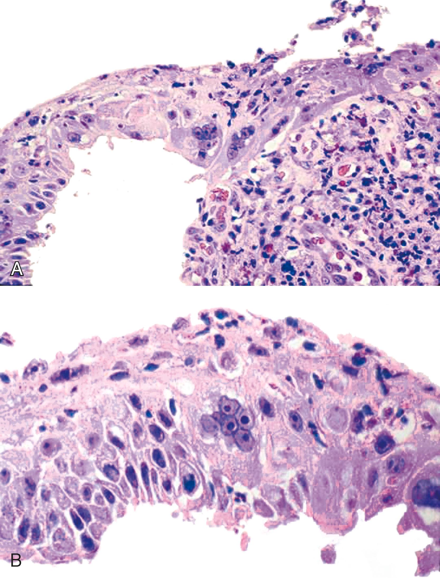 FIGURE 14.4, A and B, Multinucleated reactive epithelial cells in a patient with severe reflux esophagitis. The multinucleated reactive squamous epithelial cells are most prominent in the basal layer and in areas of mucosa adjacent to ulceration. The multinucleated cells show a low nucleus-to-cytoplasm ratio and perinuclear cytoplasmic clearing. In addition, there is prominent intercellular edema, epithelial degeneration, increased inflammation, and ulceration.