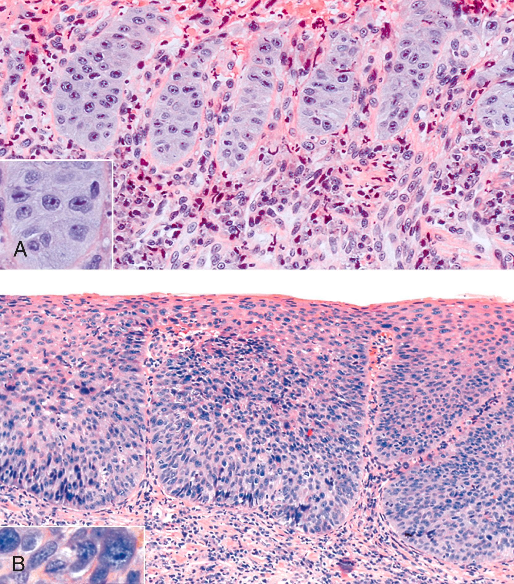 FIGURE 14.5, A, Marked reactive (pseudoepitheliomatous) hyperplasia in a patient with severe reflux esophagitis. Squamous cells are reactive and hyperchromatic and possess prominent nucleoli but do not show significant loss of polarity or nuclear overlap. The papillae are of uniform length and width, and the nuclei, although mildly atypical, are uniform in appearance (inset) . B, In high-grade squamous dysplasia, the papillae vary in size and shape, and there is considerable nuclear pleomorphism, hyperchromasia, and nuclear overlapping (inset) .