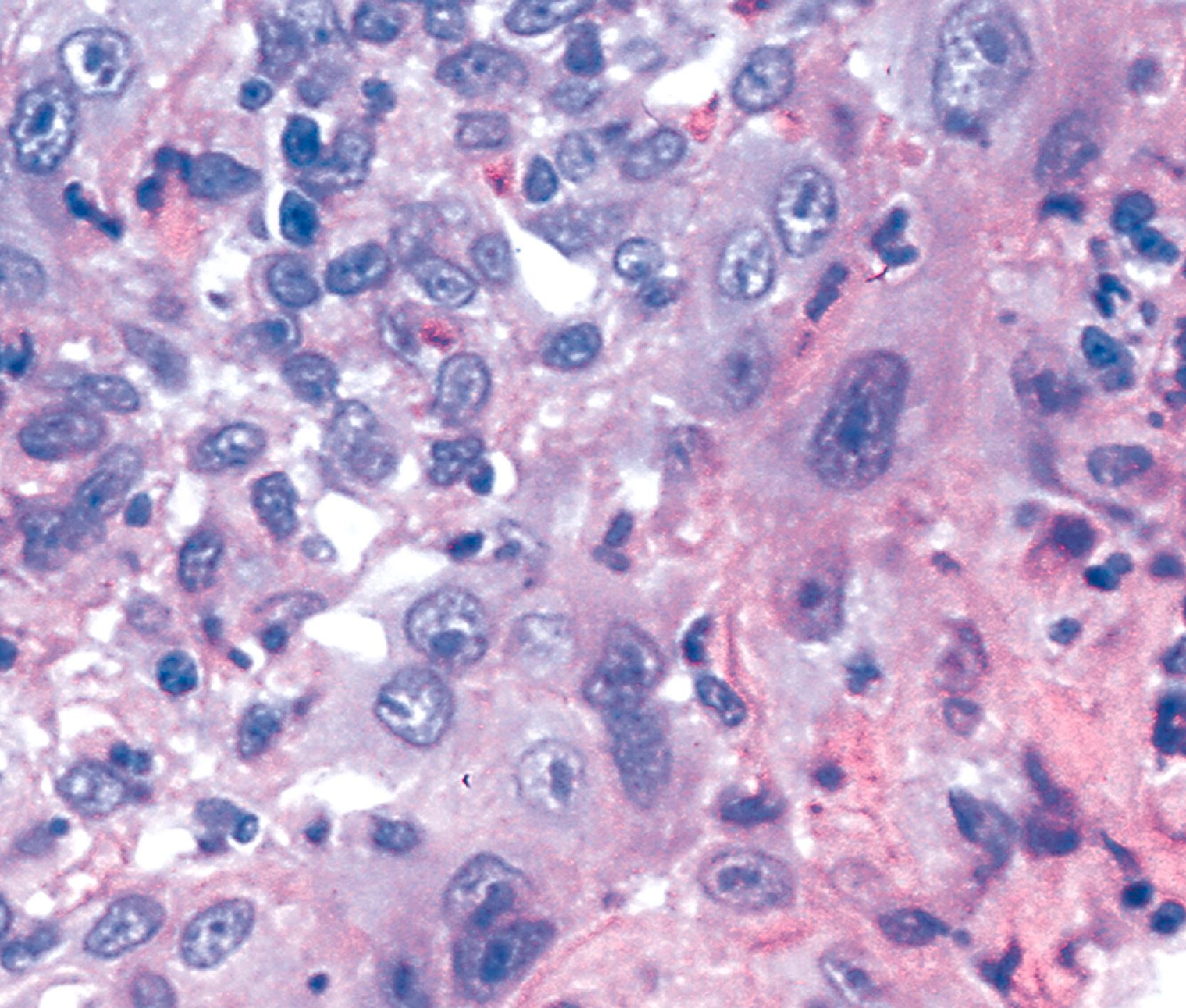 FIGURE 14.6, High-power view of the base of an esophageal ulcer showing increased inflammation and marked, somewhat atypical reactive mesenchymal cells. Although the nuclei are enlarged and irregular in shape, the nucleus-to-cytoplasm ratio of the cells is still maintained. The cells are scattered rather than grouped together, as one would expect in a malignant process.