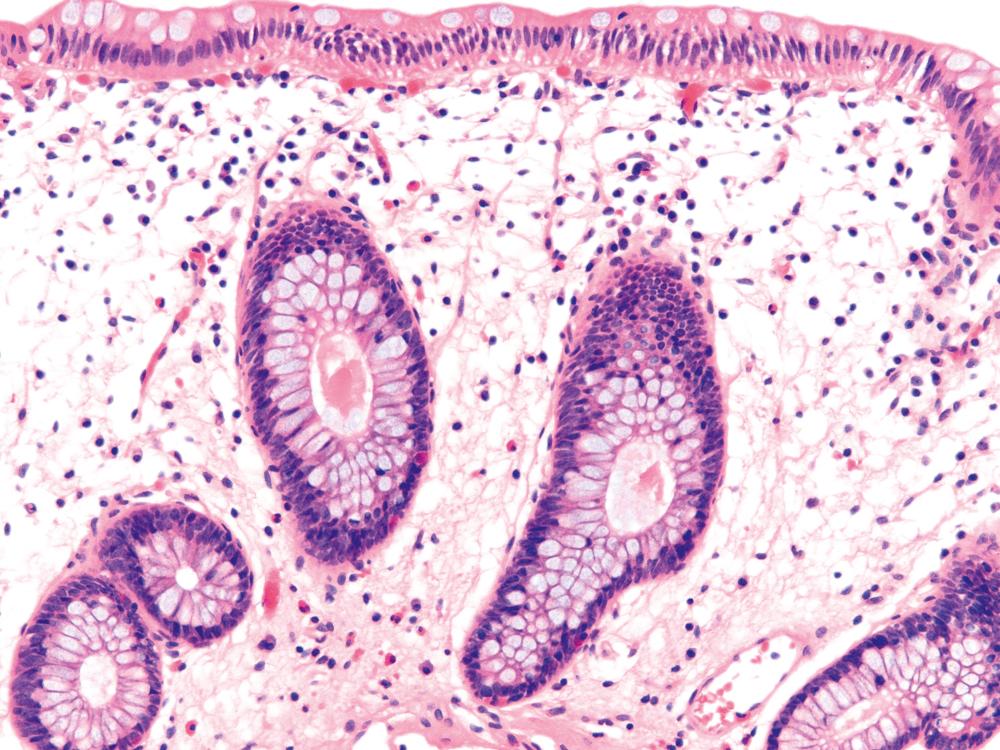 FIGURE 17.2, Colonic biopsy specimen showing lamina propria edema related to bowel preparation.