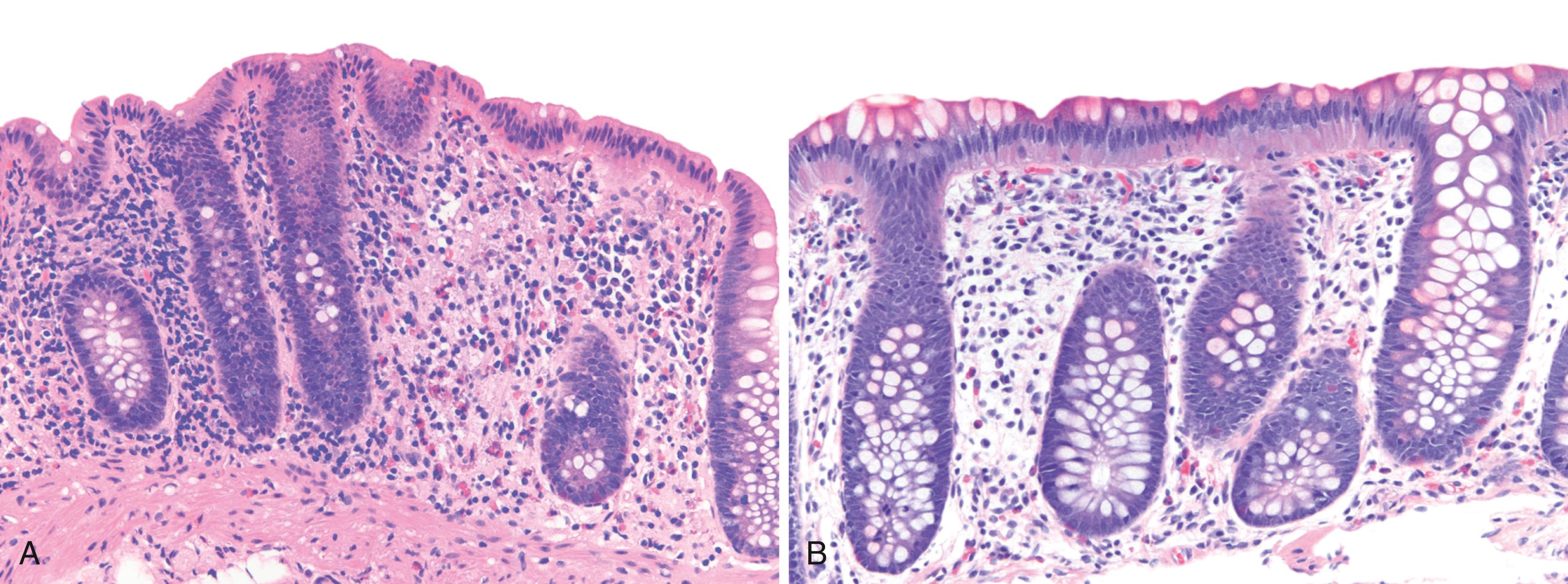 FIGURE 17.4, Biopsies from the right colon (A) and left colon (B) showing differences in the cellular constituents of the lamina propria. The lamina propria in the right colon is usually more cellular than in the left colon and shows increased numbers of lymphocytes, plasma cells, and eosinophils.