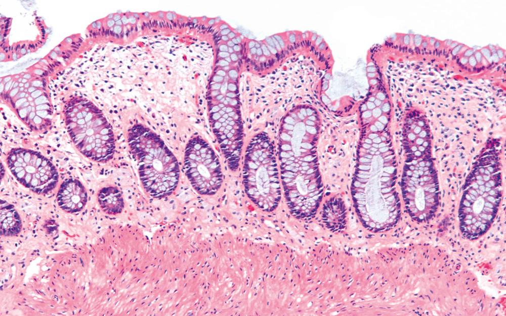 FIGURE 17.5, Normal rectal mucosa specimen showing mild crypt distortion, shortened crypts, and slight expansion of the lamina propria by muciphages. This feature should not be misdiagnosed as chronic inactive colitis.