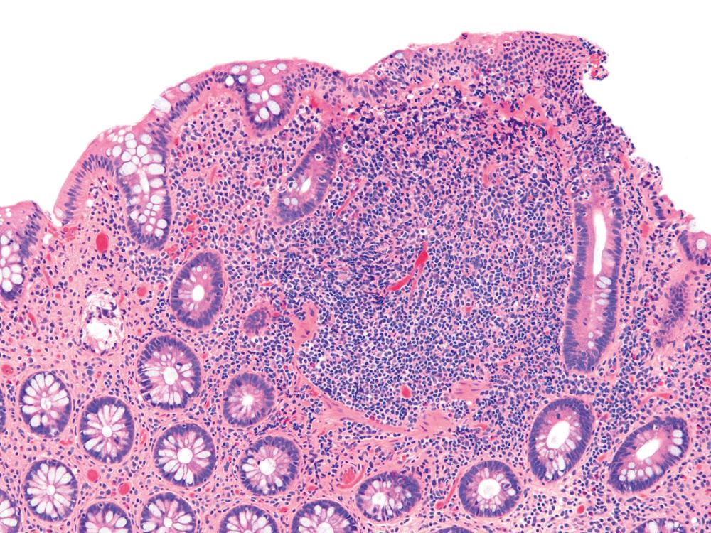 FIGURE 17.6, Colonic mucosa with lymphoid aggregate showing lymphocytes and neutrophils within the surface epithelium. This feature represents trafficking of inflammatory cells as a part of normal mucosal defense.