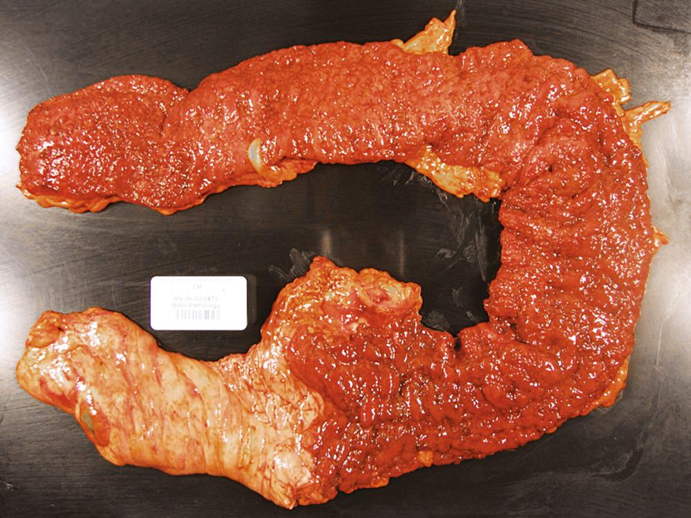 FIGURE 17.7, A gross specimen of subtotal ulcerative colitis showing diffuse continuous disease starting from the distal rectum and continuing up to the midportion of the ascending colon.