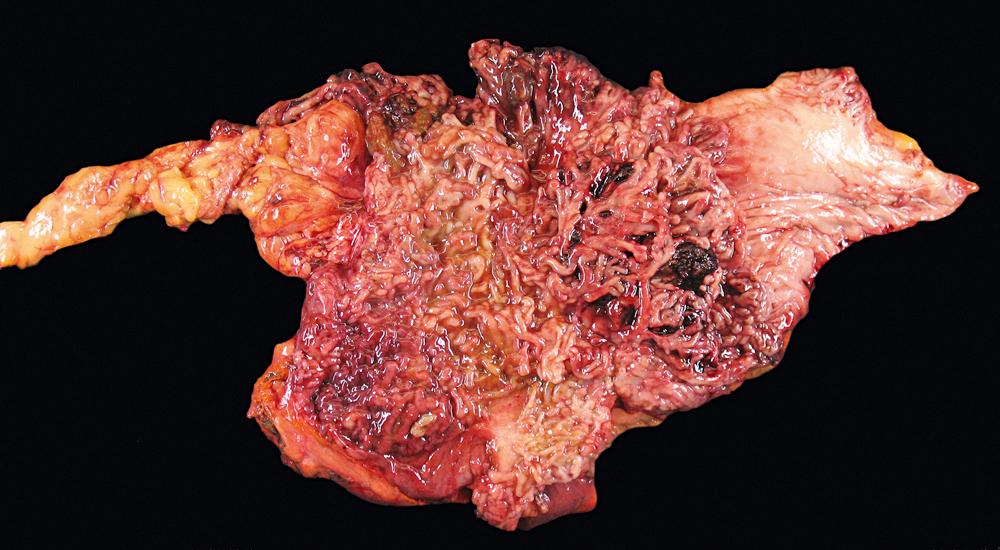 FIGURE 17.8, Gross specimen of ulcerative colitis showing numerous filiform polypoid mucosal projections that represent an exaggerated form of inflammatory pseudopolyp formation (filiform polyposis).