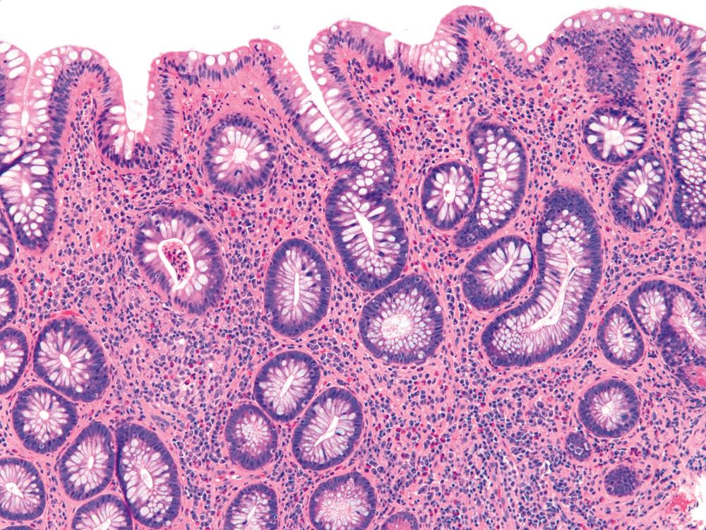 FIGURE 17.10, Distal rectum with mild chronic active ulcerative colitis .