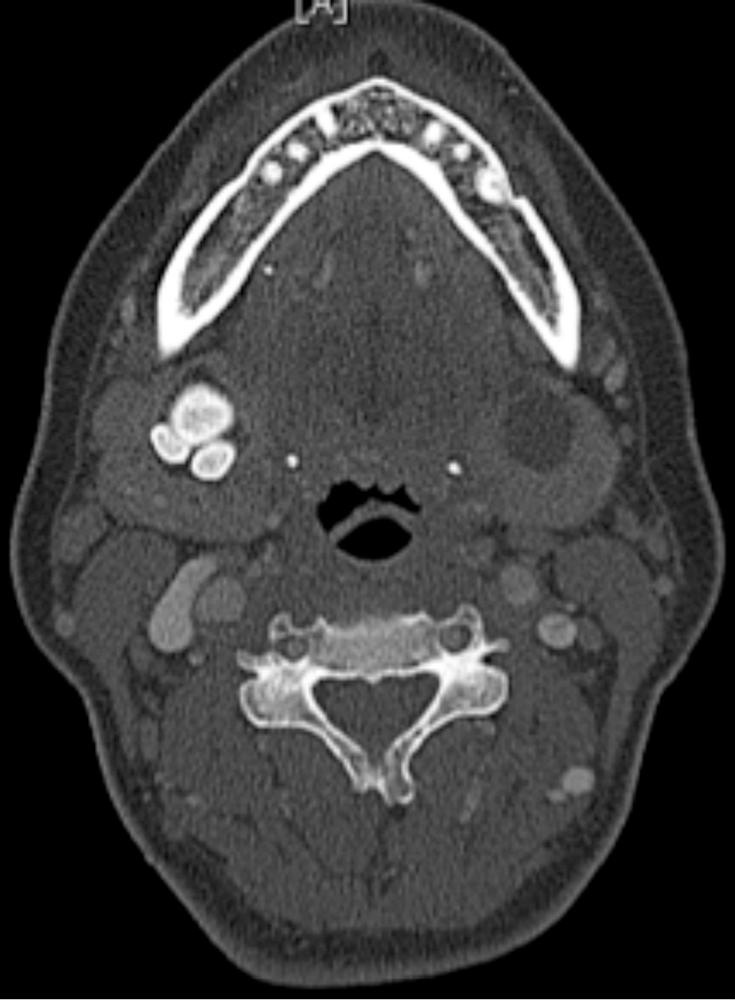 Fig. 83.1, Computed tomography with bony windowing that reveals multiple hyperdense sialoliths in the right submandibular gland.