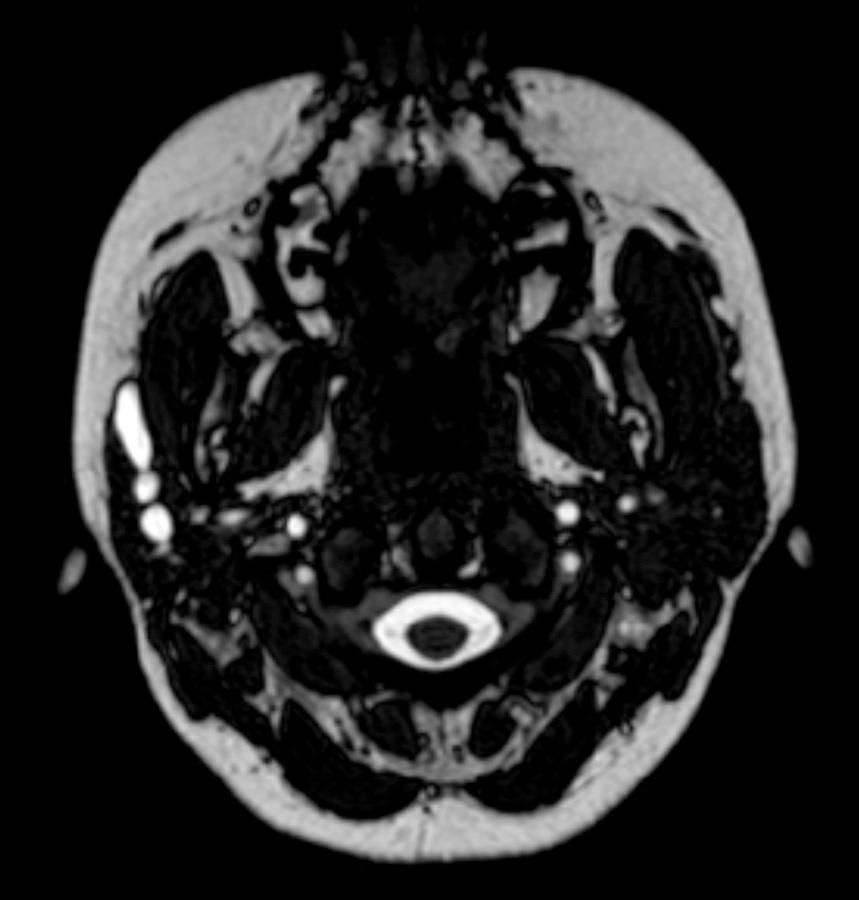 Fig. 83.2, Magnetic resonance sialography of right-sided parotid duct shows multiple areas of stenosis and dilation.
