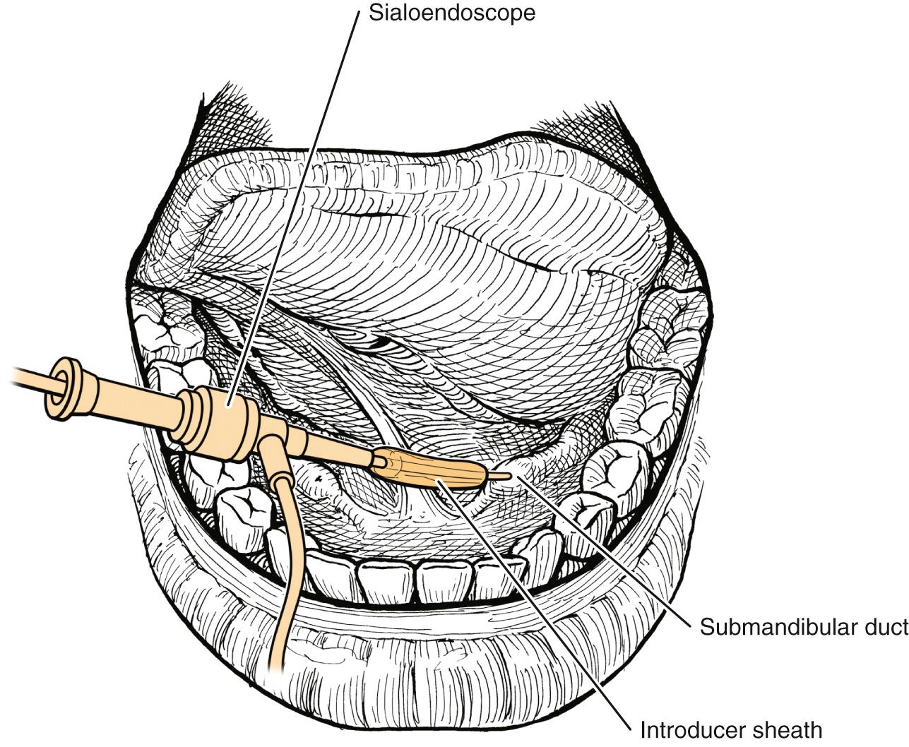 Fig. 83.3, Sialoendoscope inserted through introducer sheath in cannulated papilla of submandibular duct.