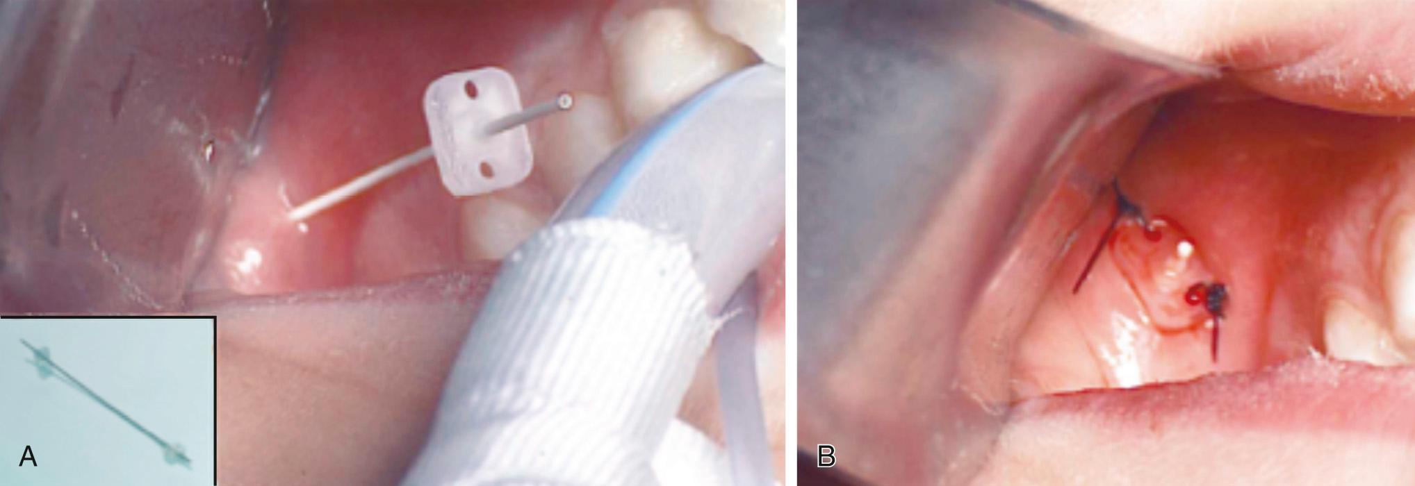 Fig. 83.7, A 1-mm Walvekar salivary stent. Left inferior inset shows double-headed stent with each end ergonomically oriented to the submandibular and parotid ducts. (A) Insertion into right parotid duct. (B) Stent inserted and sutured with individual 4-0 nylon stitches or a loop stitch.