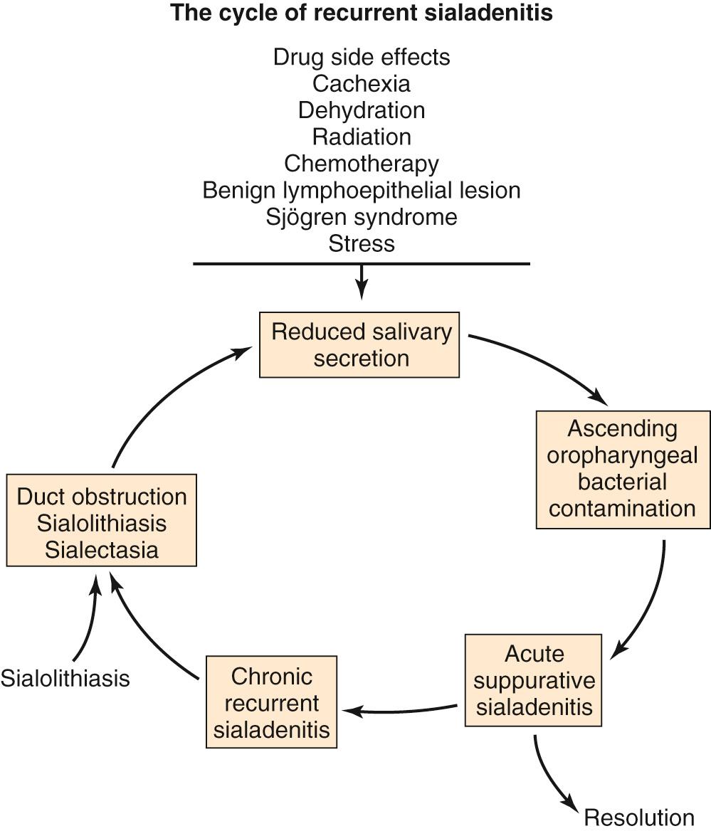 Fig. 83.8, Pathophysiology and predisposing factors for the development of acute and chronic suppurative sialadenitis.